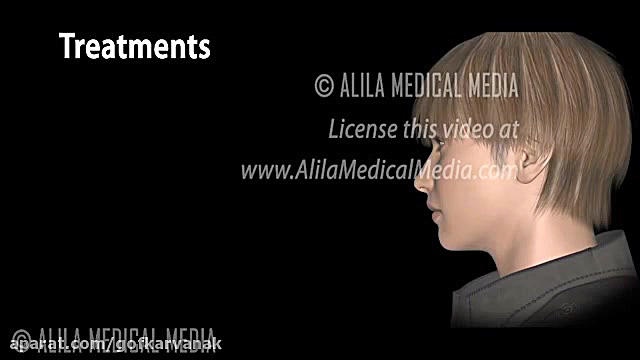 نکات مهم در درمان اختلال بلع بعد از سکته مغزی|09120452406 بیگی| ترمیم سوختگی