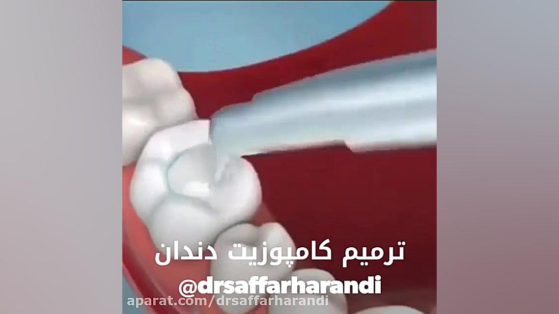 فیلم ترمیم کامپوزیت دندان پالپوتومی