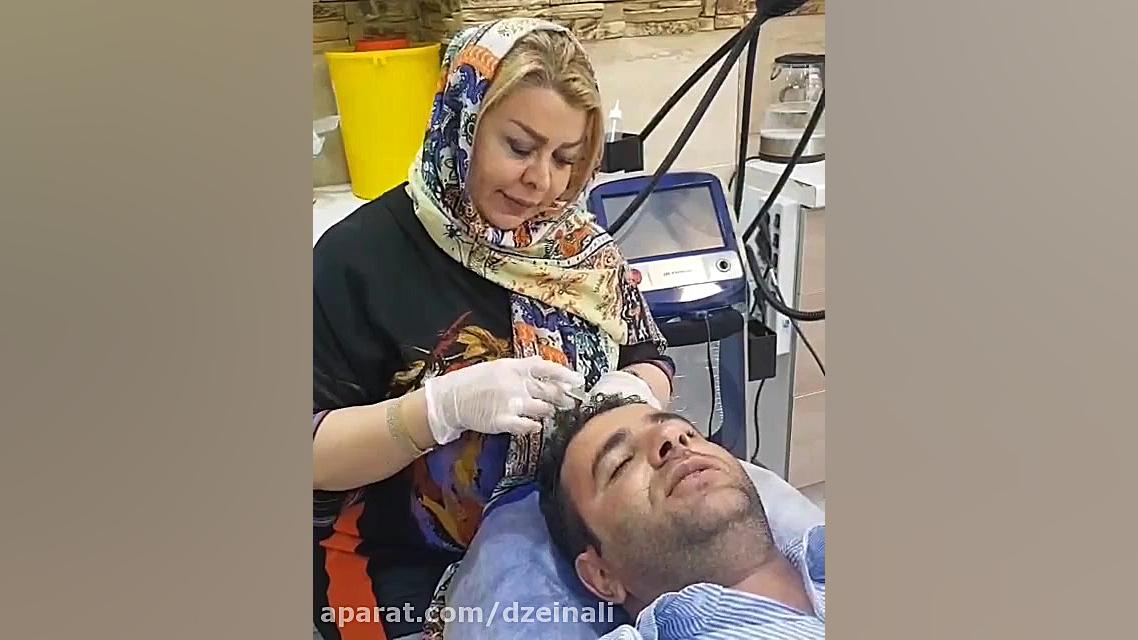 تزریق مزوتراپی برای درمان ریزش موی مردانه (Androgenitic alopecia) لیفت گردنایمپلنت دندان