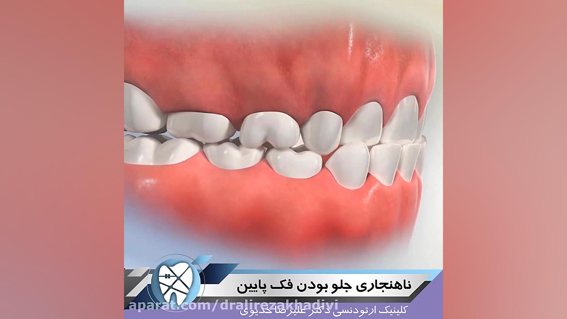ناهنجاری جلو بودن فک پایین دکتر علیرضا خدیوی