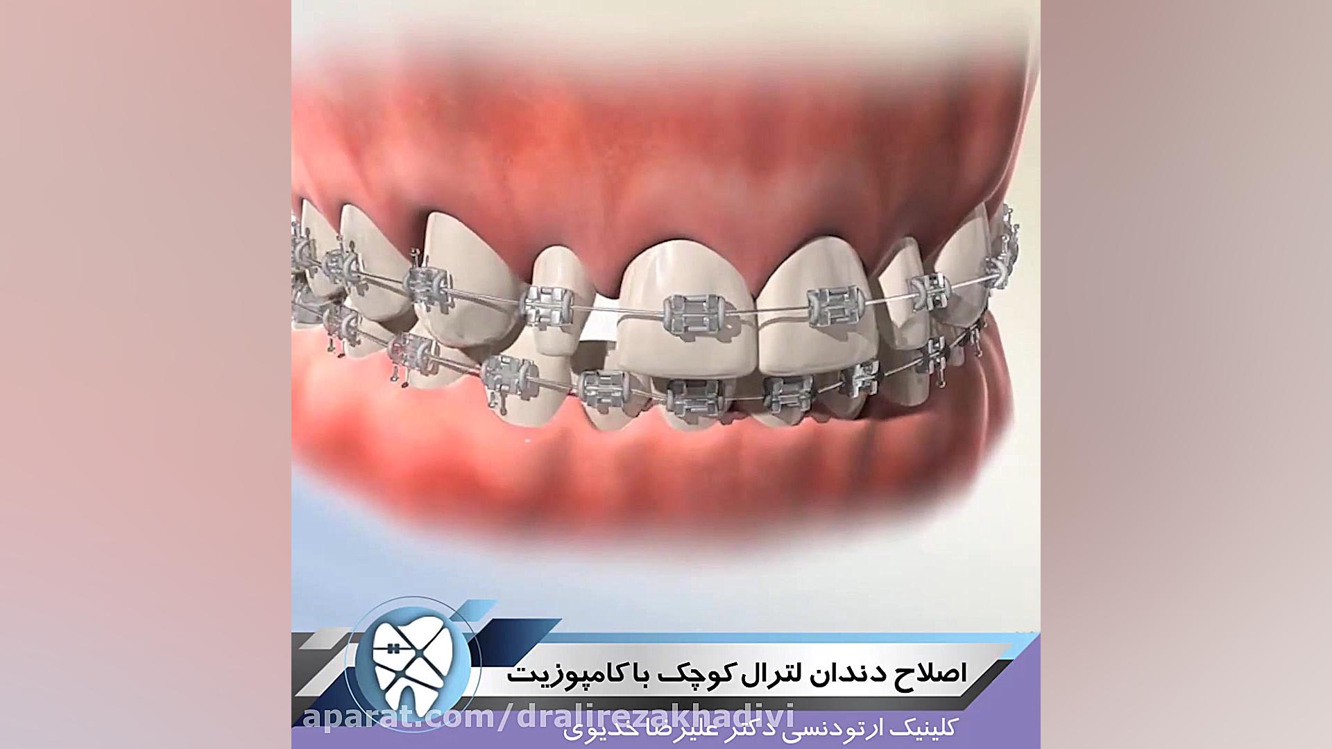 اصلاح دندان لترال کوچک با کامپوزیت دکتر علیرضا خدیوی