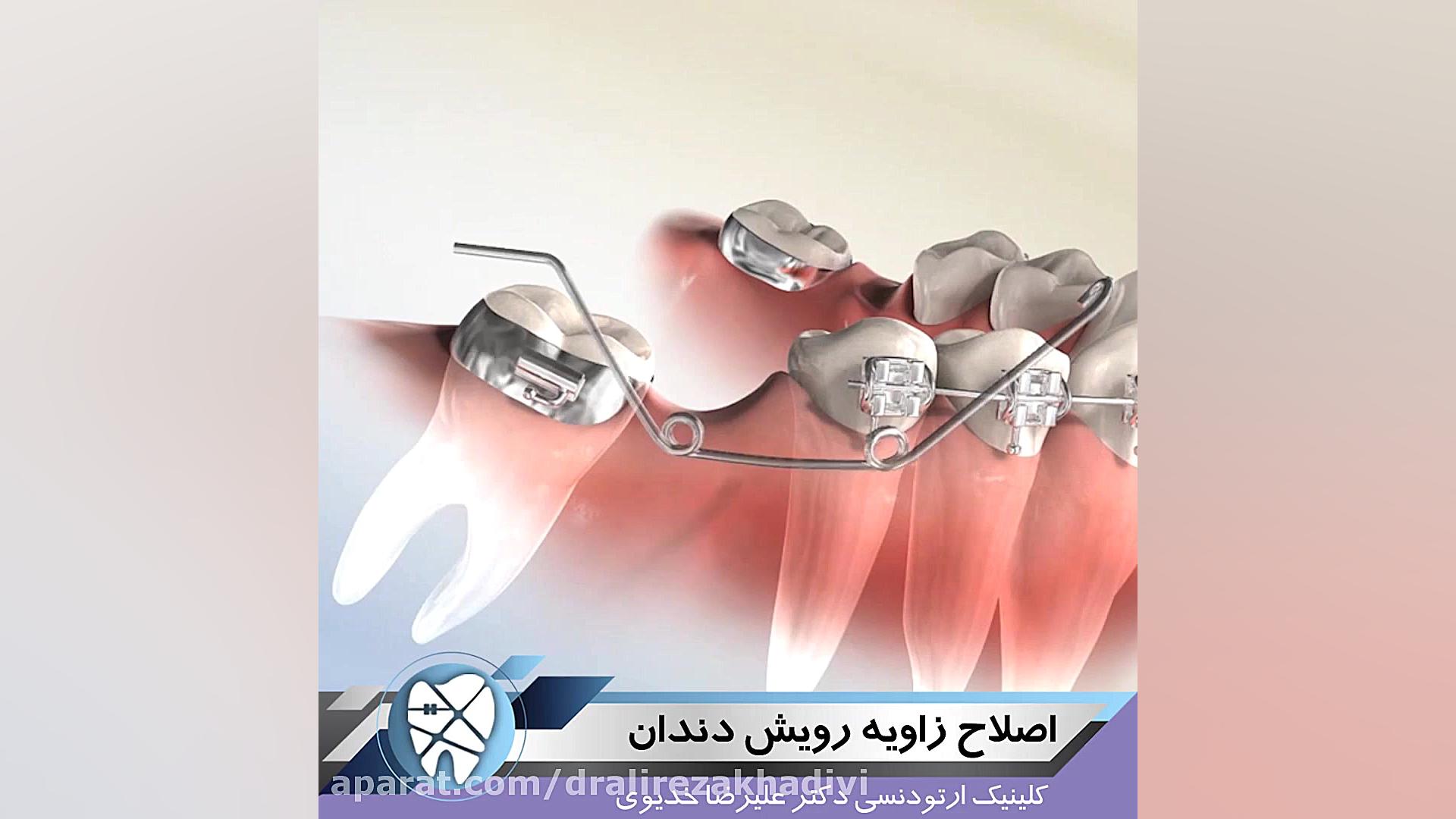 اصلاح زاویه رویش دندان دکتر علیرضا خدیوی