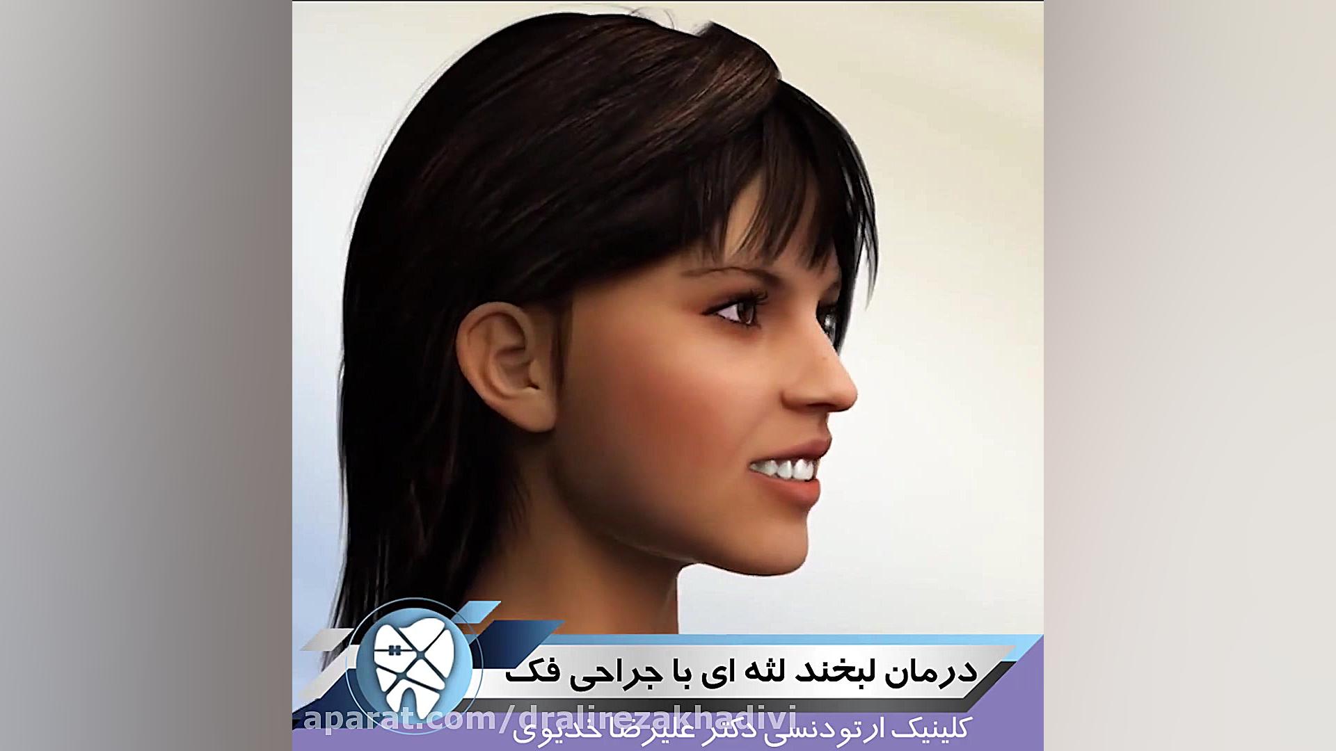 درمان لبخند لثه ای با جراحی فک دکتر علیرضا خدیوی