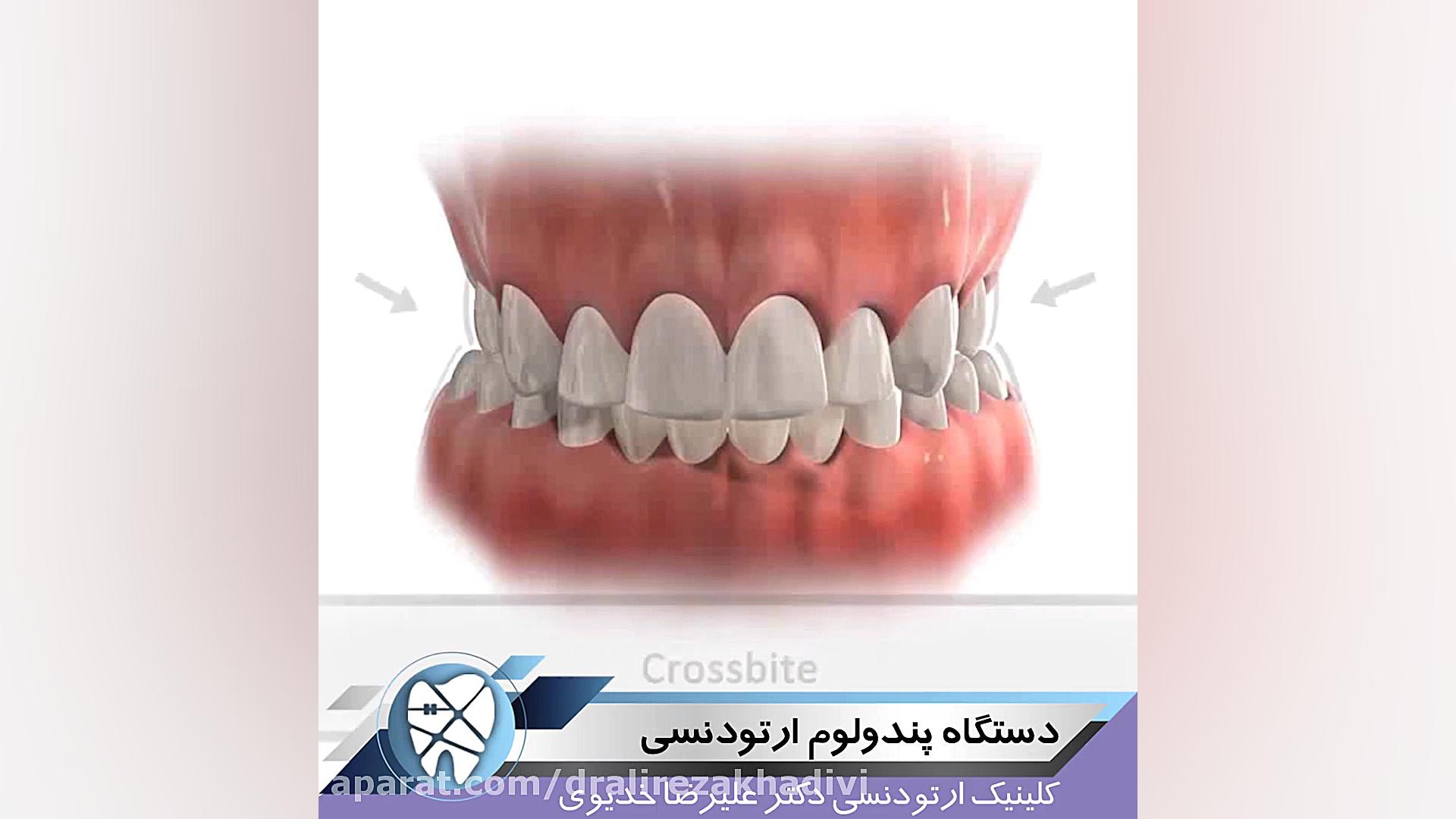 دستگاه پندولوم ارتودنسی دکتر علیرضا خدیوی