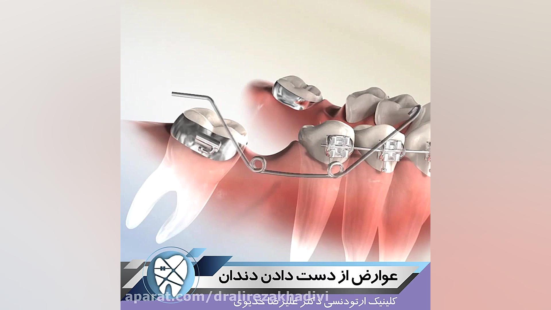 عوارض از دست دادن دندان دکتر علیرضا خدیوی