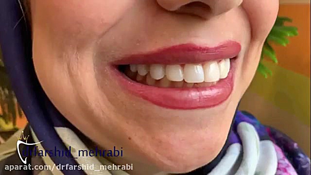 کامپوزیت دندان دستگاه لیزر پالس فمتوثانیه
