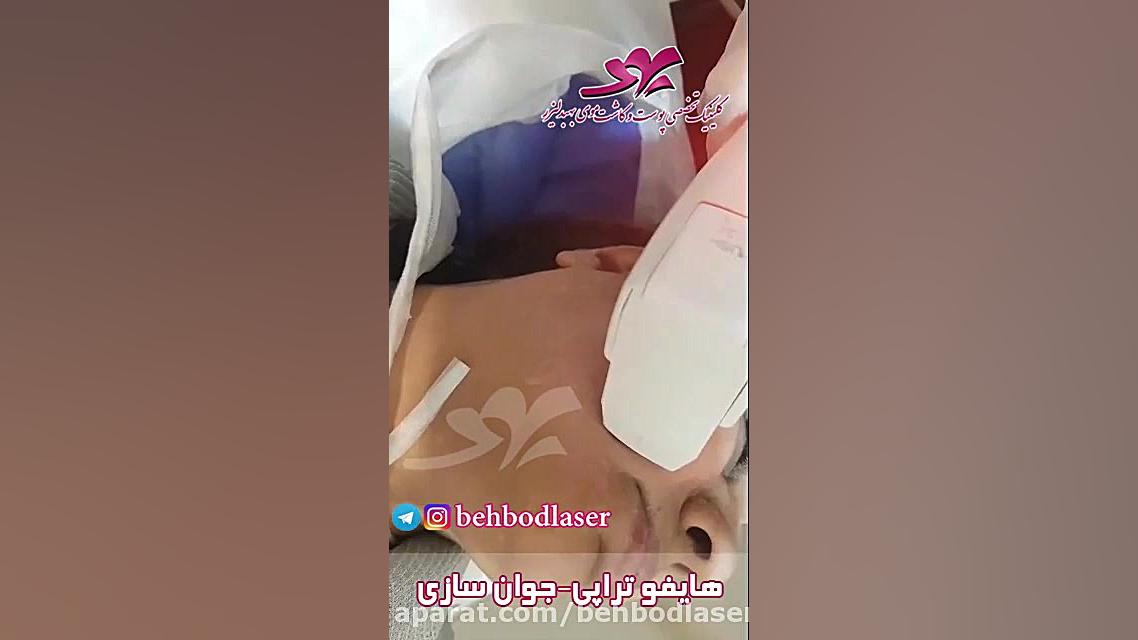هایفو تراپی جوان سازی-کلینیک تخصصی پوست بهبد لیزر کرج کلینیک لیزر