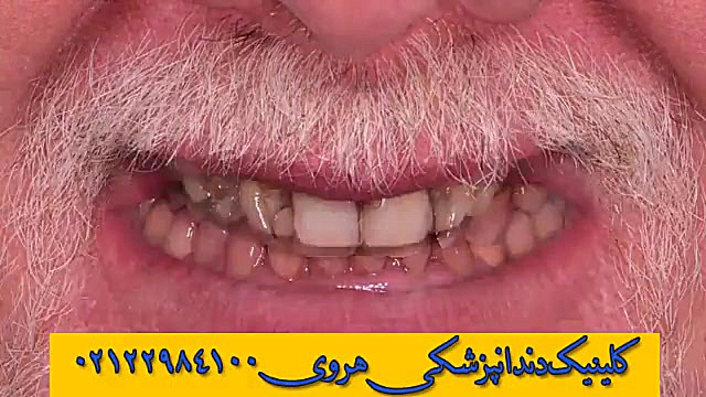 ترمیم دندان ها - نقش کامپوزیت و لمینت در زیبایی دندان ها آزمایش بلوغ ریوی جنین