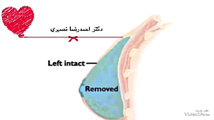تخلیه بافت سینه سرطانی و قرار دادن گسترش دهنده دکتر احمدرضا نصیری