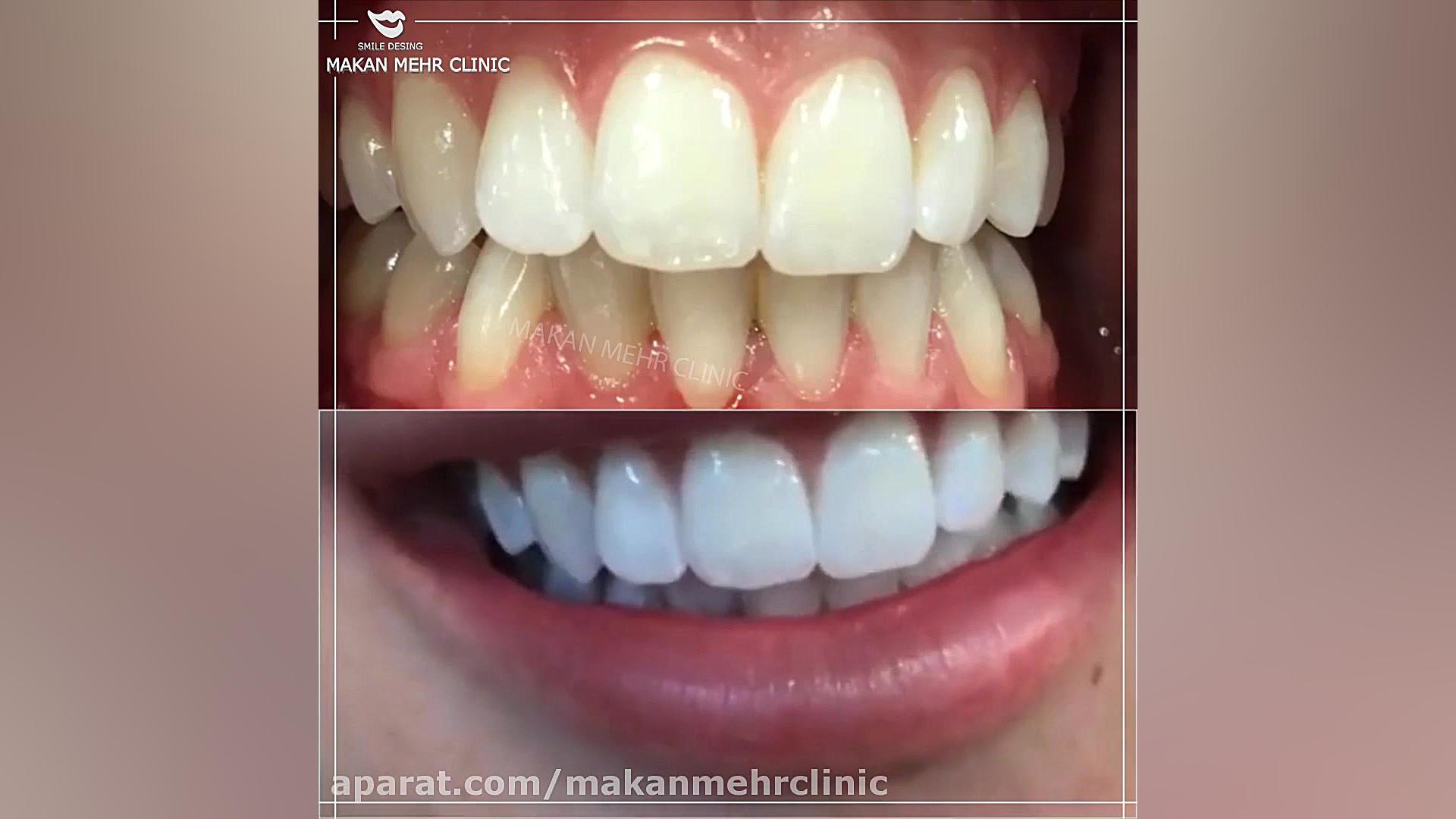 نمونه کار اصلاح طرح لبخند تری‌متازیدین