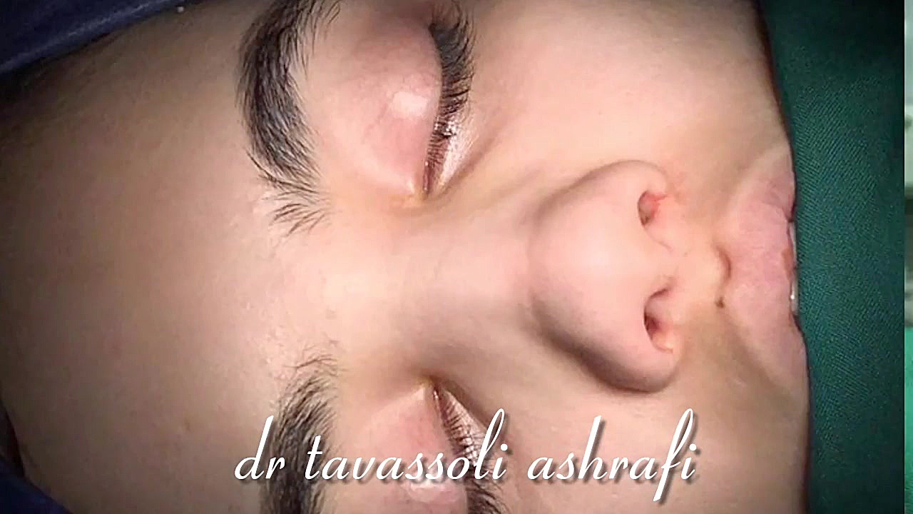 بیشترین بازدید کلیپ جراحی بینی در ایران ۰۹۳۶۲۰۹۹۹۶۹ جراحی بینی دکتر احمد توسلی اشرفی