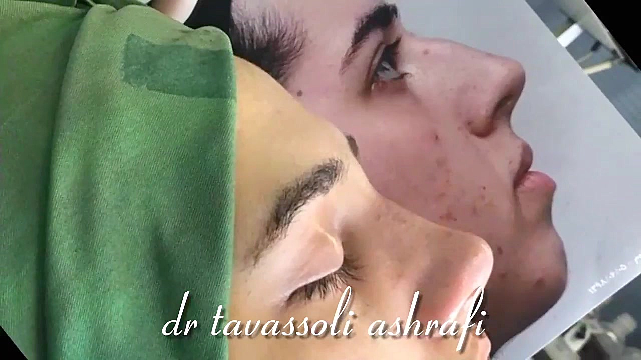 بیشترین بازدید کلیپ جراحی بینی در ایران ،بدون رد بخیه و برش۰۹۳۶۲۰۹۹۹۶۹ جراحی بینی دکتر احمد توسلی اشرفی