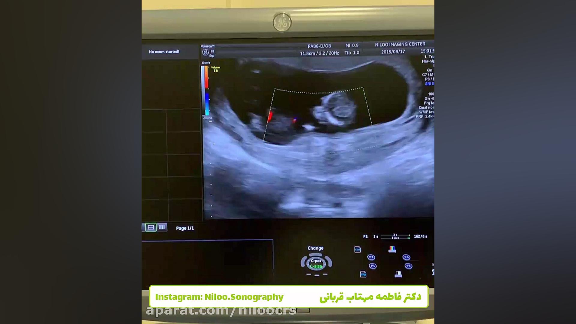 بند ناف تک شریانی سونوگرافی نیلو دکتر فاطمه مهتاب قربانی