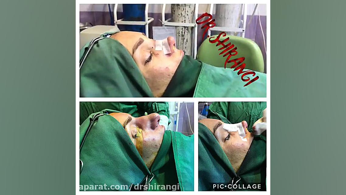 فیلم عمل جراحی زیبایی بینی زنانه دکتر سعید شیرنگی (فوق تخصص جراحی پلاستیک و زیبایی)