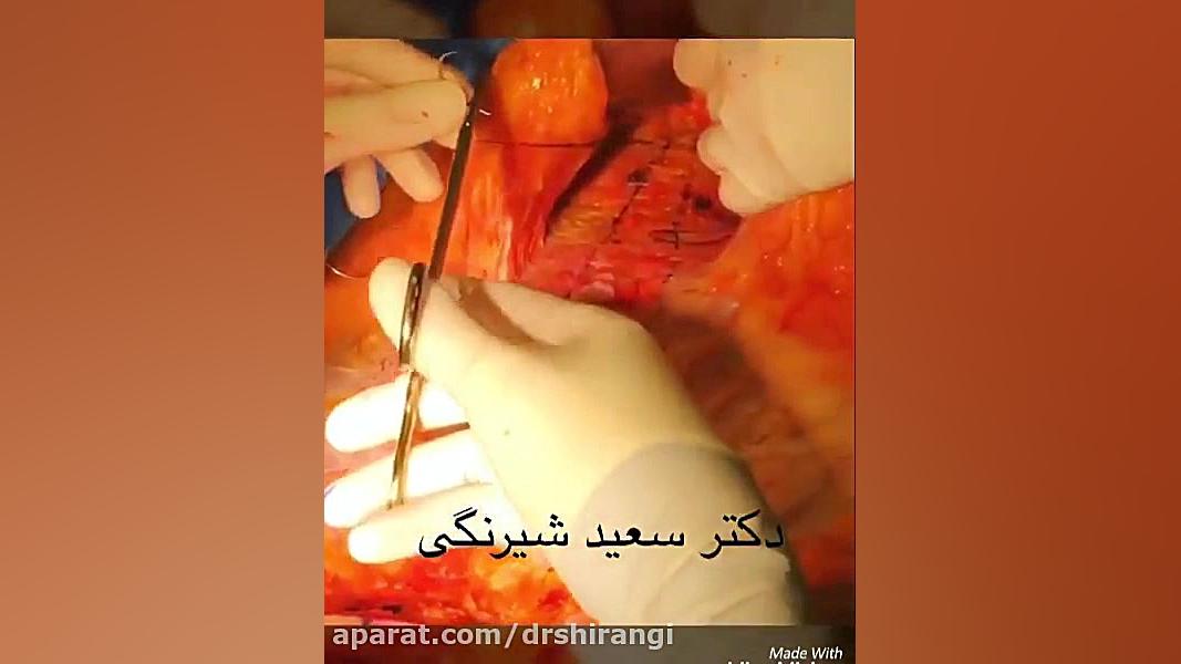 فیلم جمع کردن عضلات شکم در جراحی ابدومینوپلاستی دکتر سعید شیرنگی (فوق تخصص جراحی پلاستیک و زیبایی)