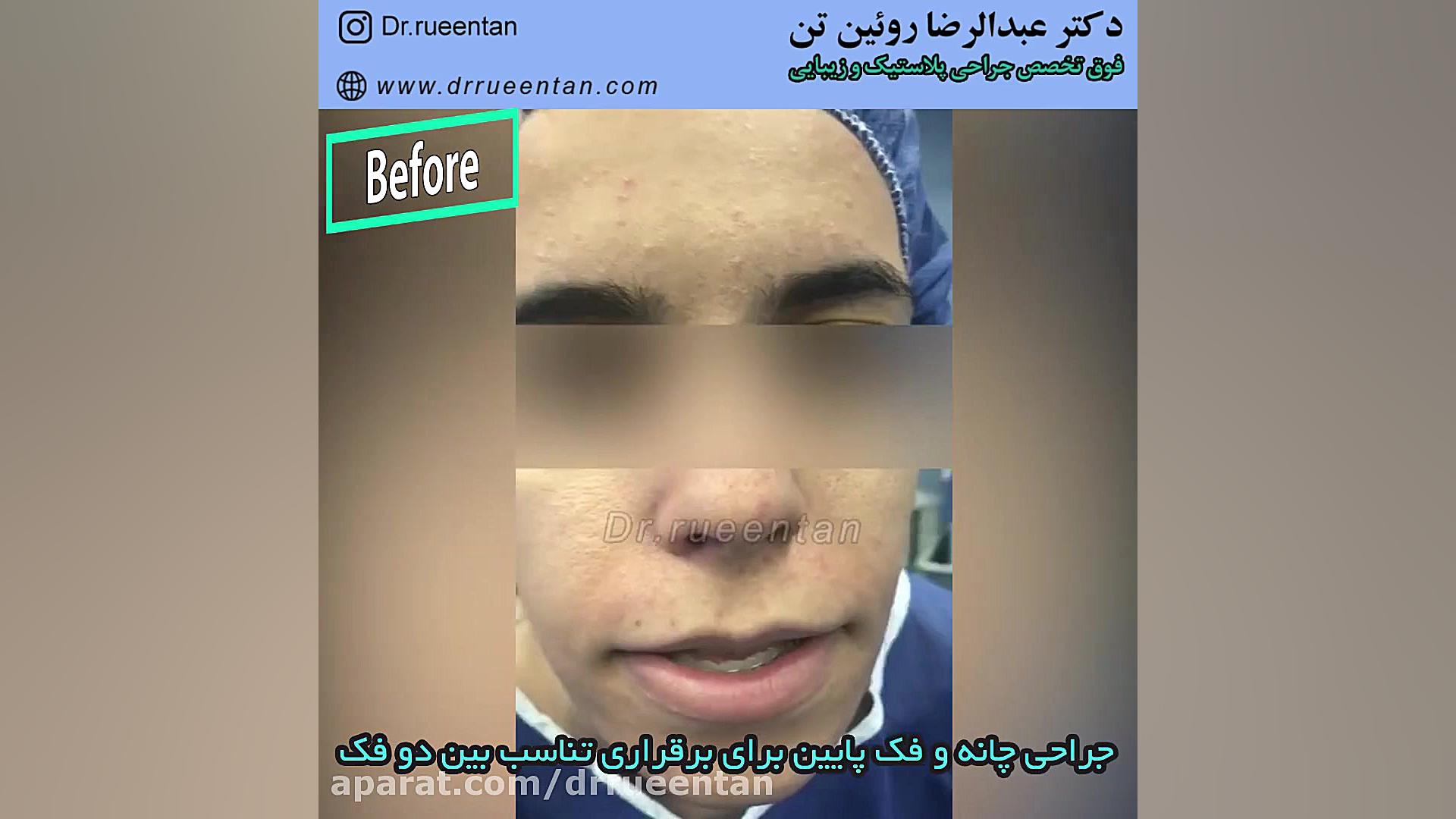 جراحی چانه و فک پایین دکتر عبدالرضا روئین تن
