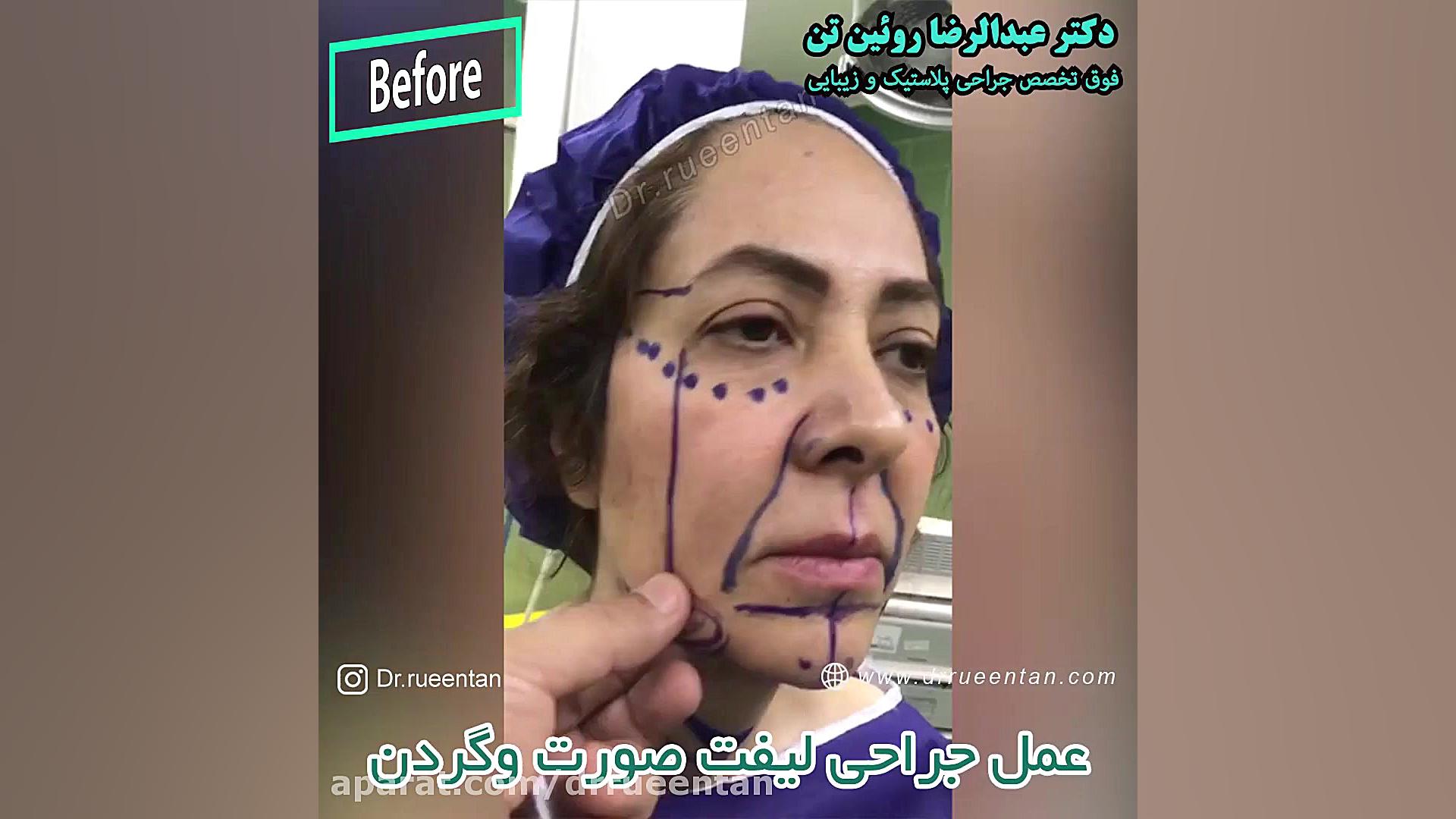 عمل جراحی لیفت صورت و گردن دکتر عبدالرضا روئین تن