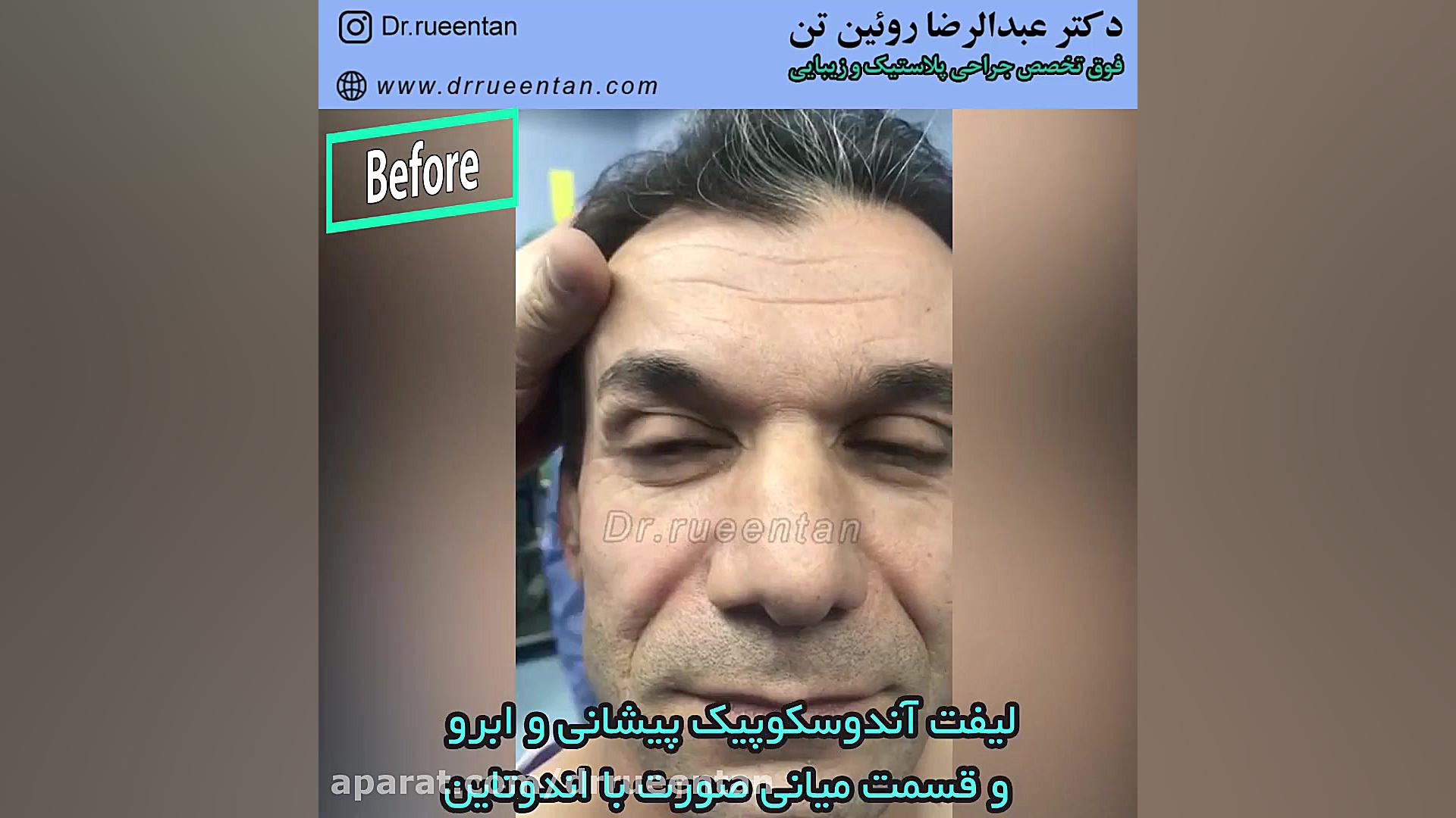لیفت آندوسکوپیک دکتر عبدالرضا روئین تن