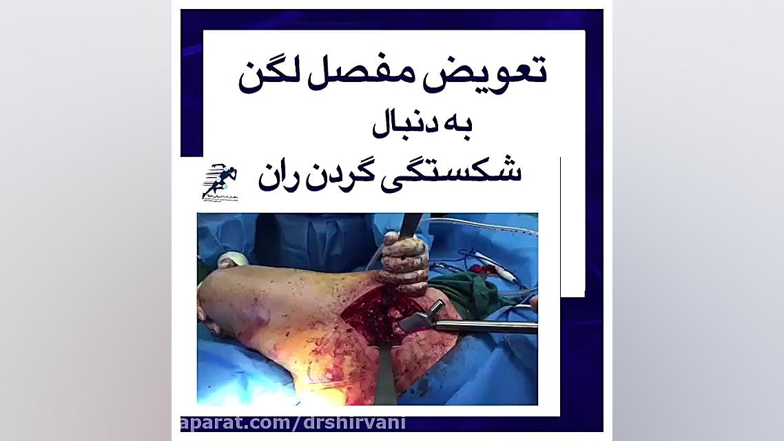 فیلم تعویض مفصل لگن به دنبال شکستگی گردن استخوان ران اسکرین‌شات