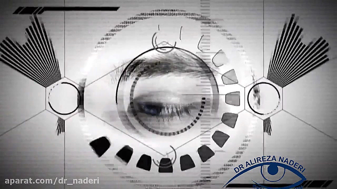عمل آب مروارید به روش فیکو-مرکز چشم پزشکی دکتر علیرضا نادری مرکز چشم پزشکی دکتر علیرضا نادری www.dr-naderi.com