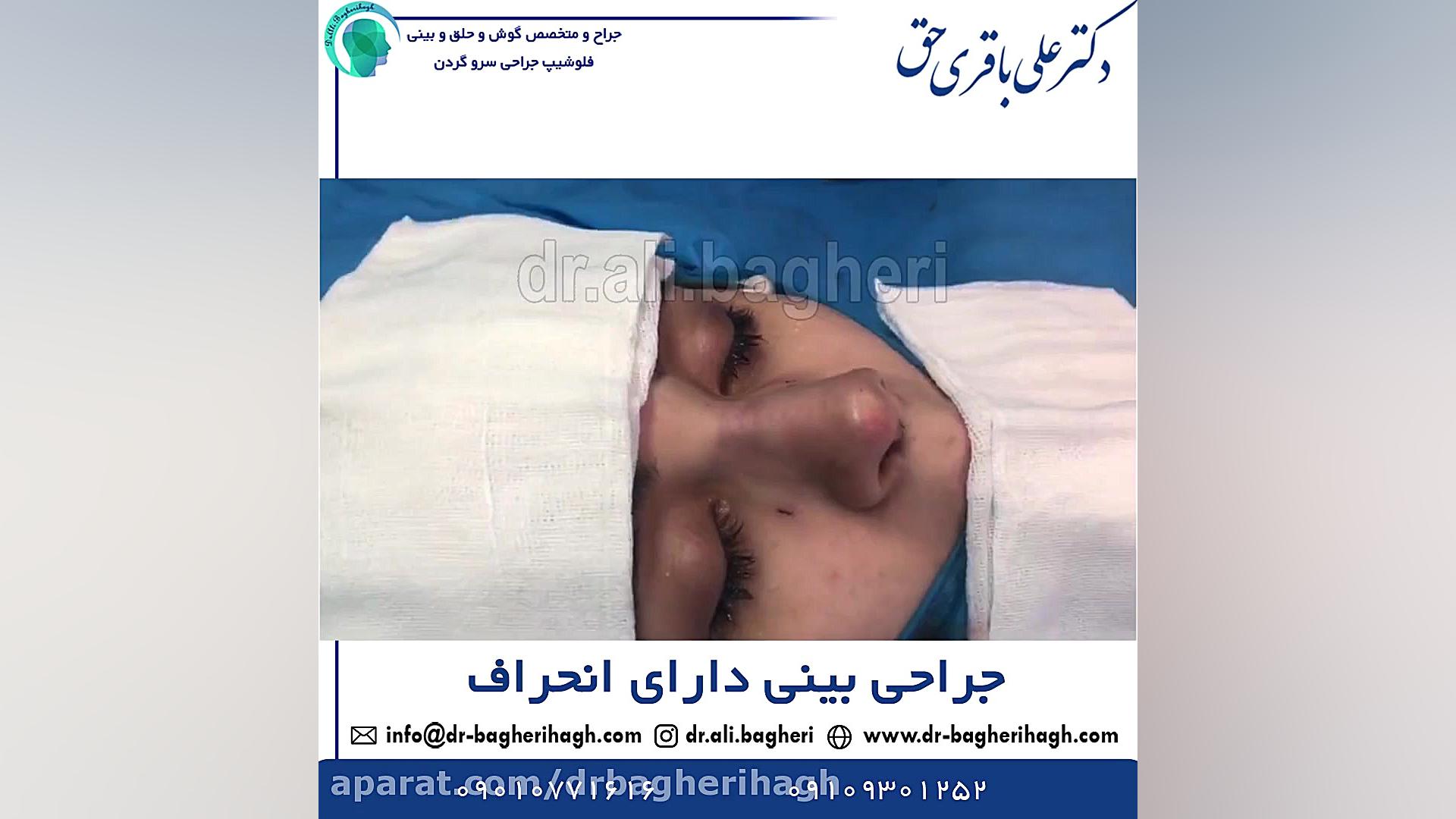 جراحی بینی دارای انحراف دکتر علی باقری حق