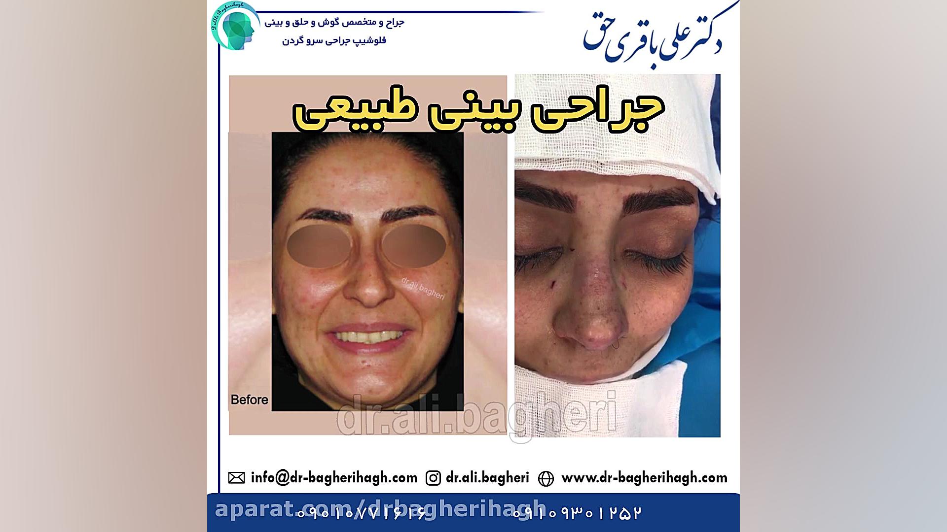 جراحی بینی طبیعی دکتر علی باقری حق