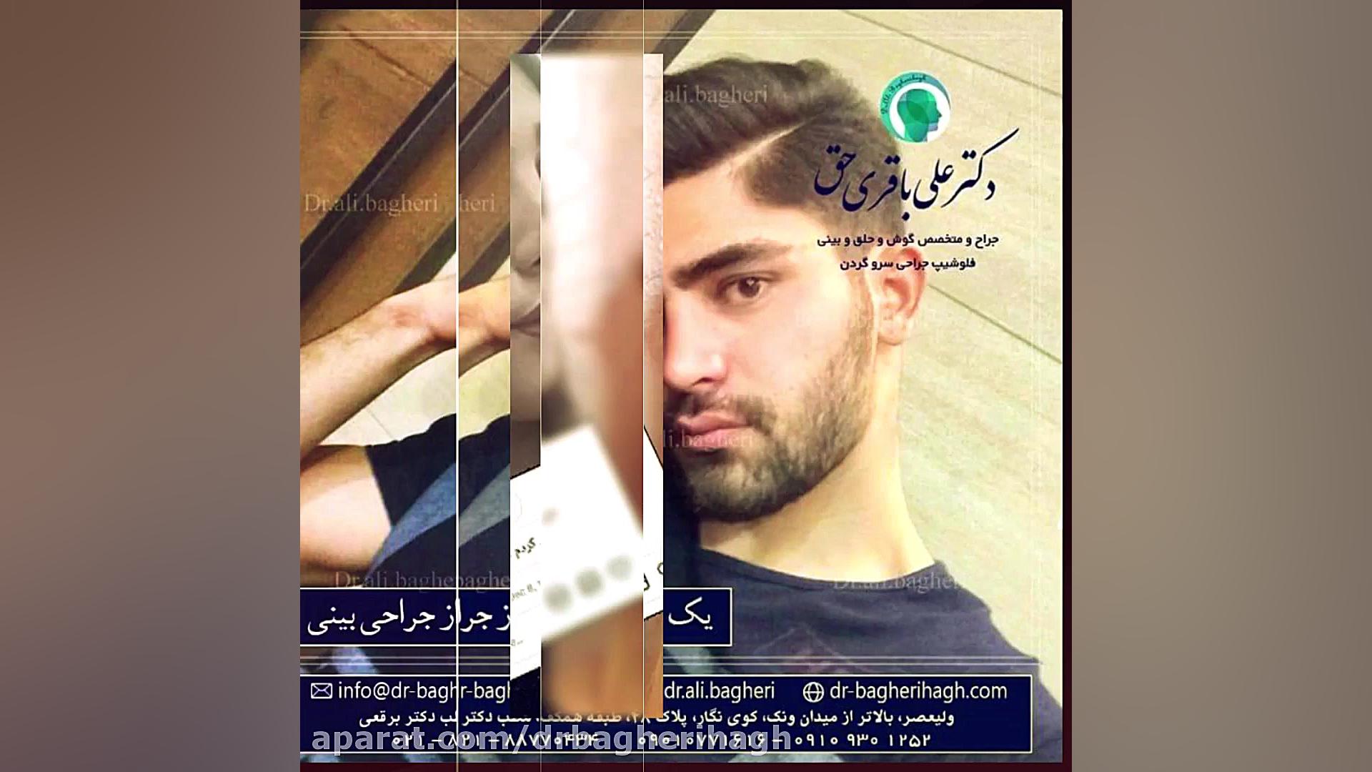 نمونه کار جراحی بینی دکتر علی باقری حق