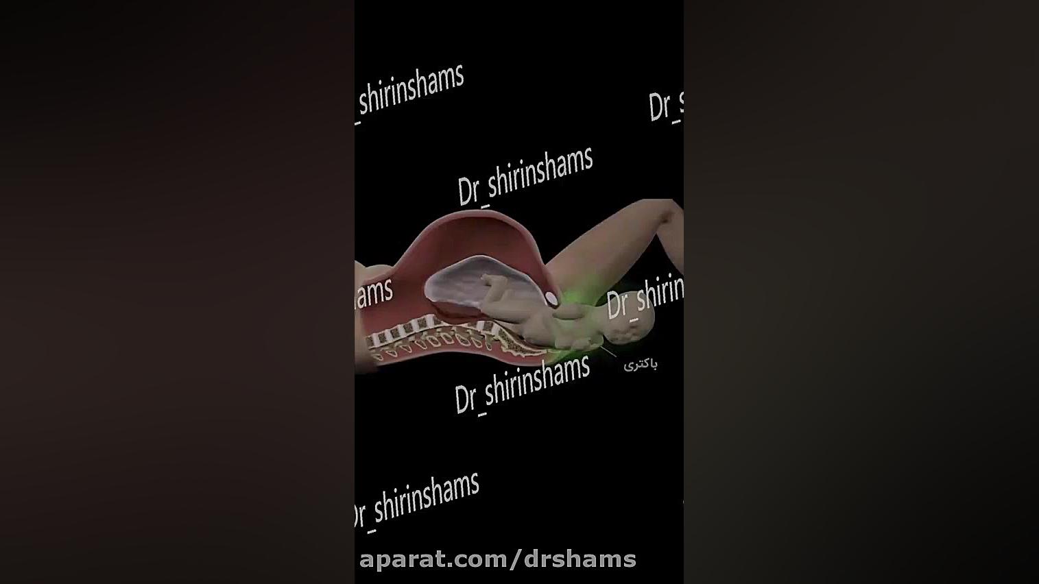 عفونت ناحیه تناسلی در بارداری خطرناک است؟؟؟ دکتر شیرین شمس جراح و متخصص زنان و زایمان