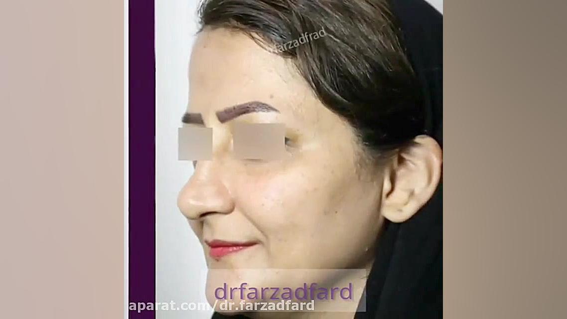 ماندگاری تزریق چربی صورت دکتر اسماعیل فرزاد فرد - فوق تخصص پلاستیک