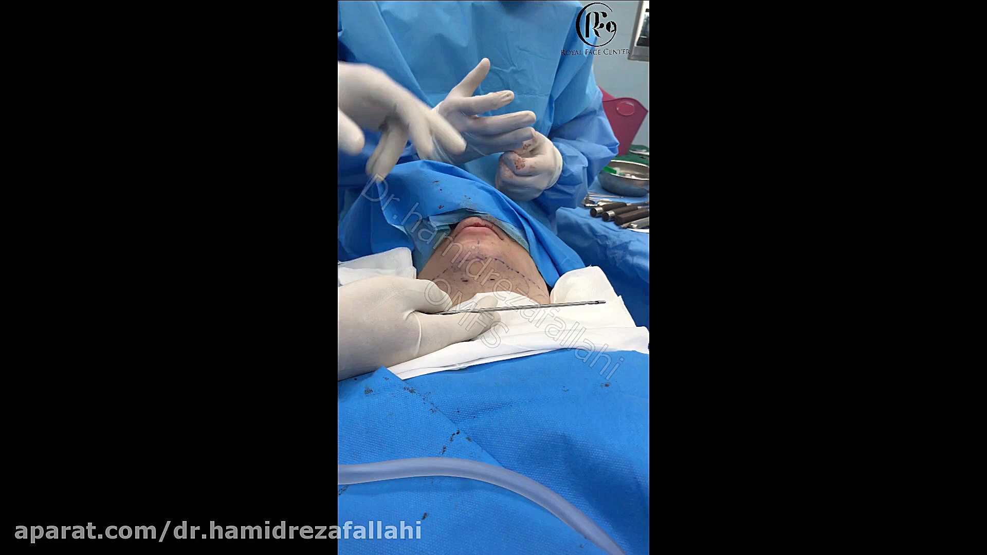 لیپوساکشن گردن دکتر حمیدرضا فلاحی