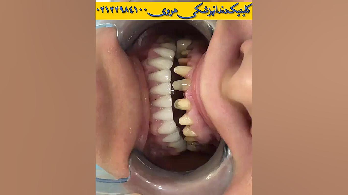 روکش لمینت دندان کلینیک پوست
