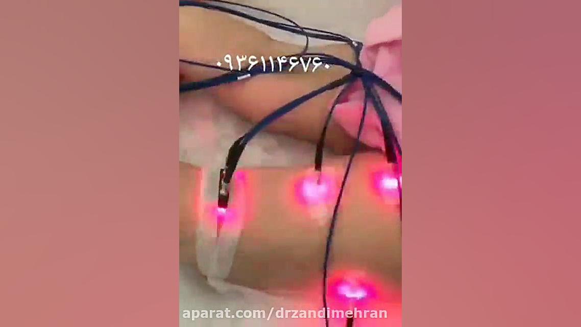 لیزر کم توان نسل ۴، لیزر رزونانس و مولتی لیزر اکوپانکچر موثر در فیبرومیالژیا پرتاب نعل