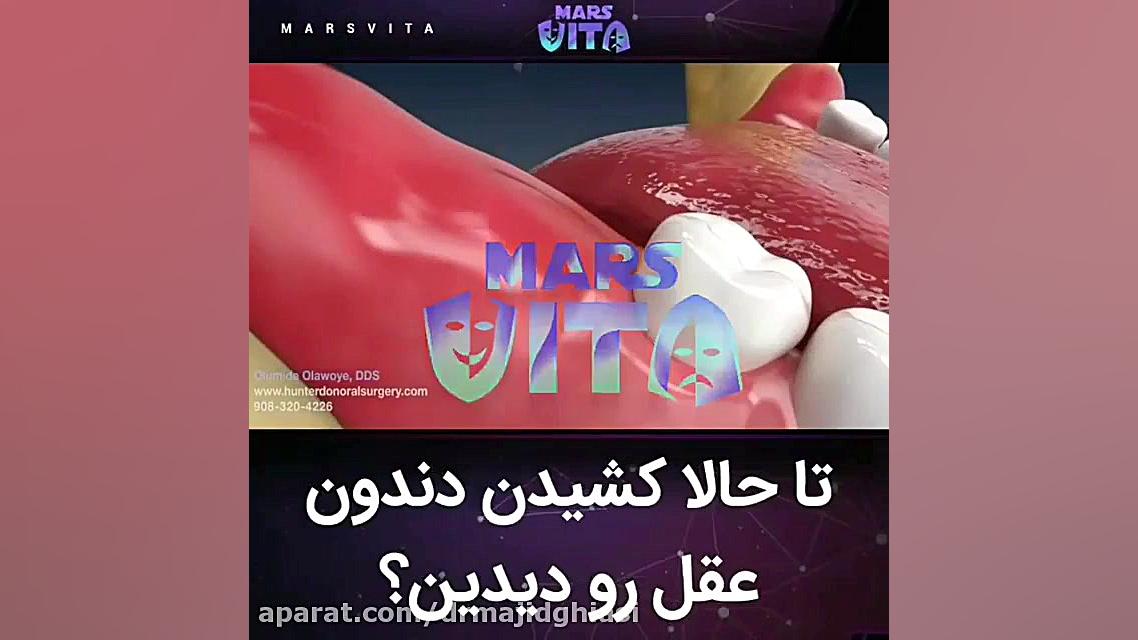 جراحی دندان عقل -دکترمجیدقیاسی دندانپزشک زیبایی مشهد دستگاه DNA-Chip