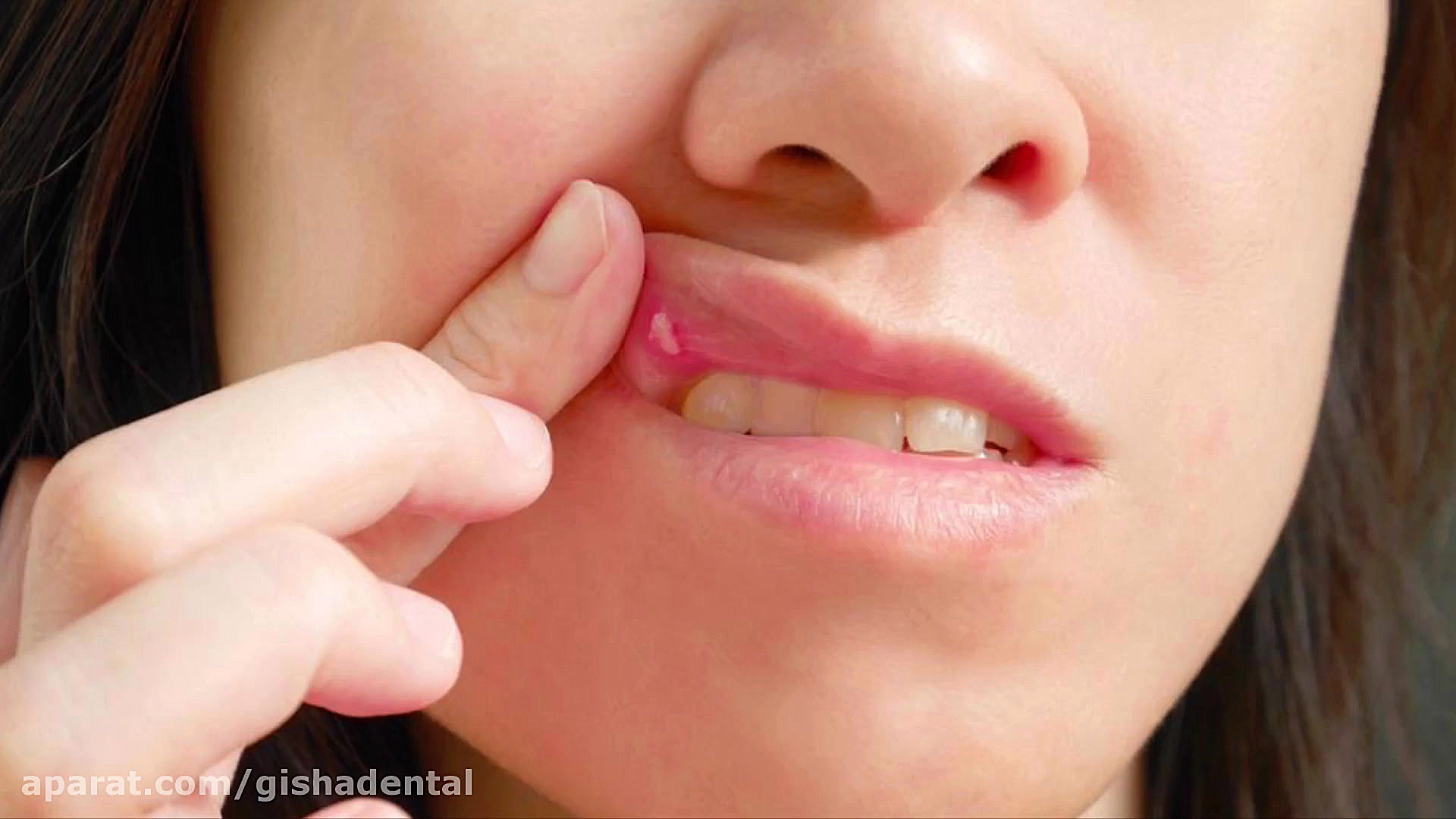 دندان مصنوعی چه مشکلاتی دارد؟ کلینیک دندانپزشکی دکتر عزیز گشاده رو