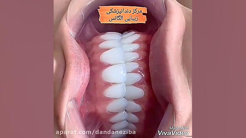 بهترین مارک کامپوزیت دندان | مزایای لمینیت کامپوزیتی | بهترین دندانپزشک زیبایی تست تراشه ژنی