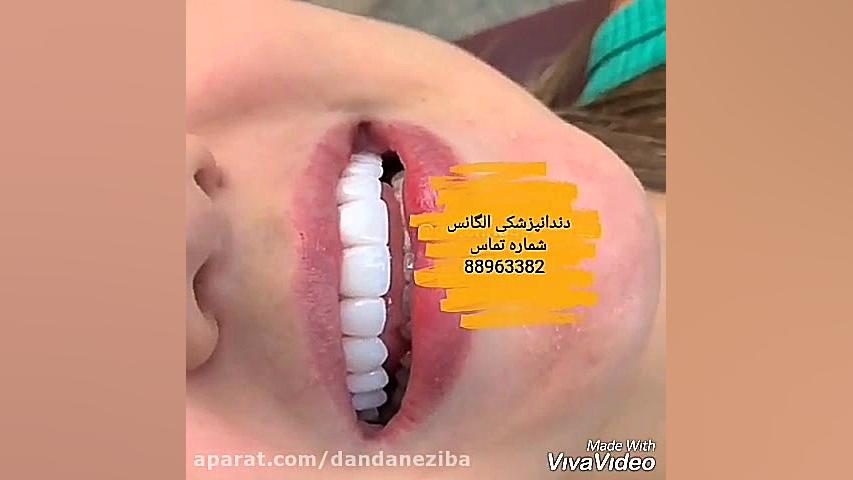 ترمیم لمینیت دندان چگونه است | طریقه لمینیت کردن دندان | لامینیت دندان برداشتن خال گوشتی