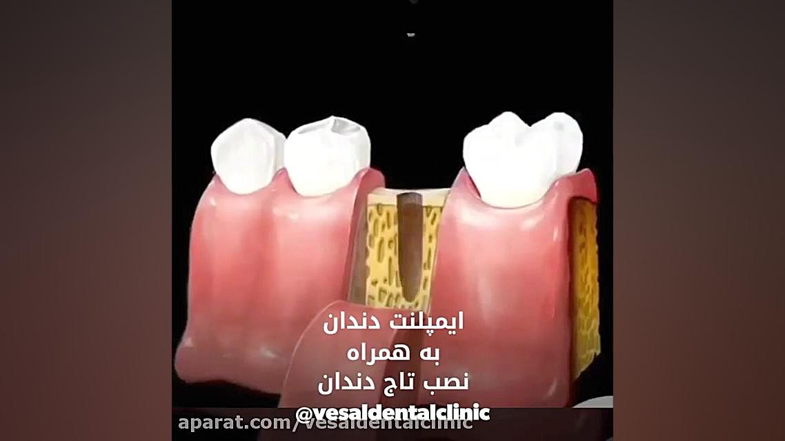 ایمپلنت دندان و نصب تاج اندودنتیکس