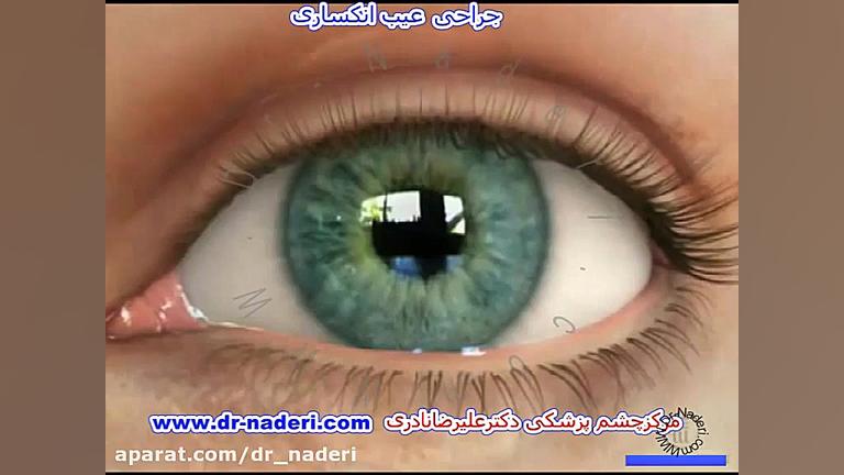 آمادگی برای عمل پی آر کی در اتاق عمل لیزر مرکز چشم پزشکی دکتر علیرضا نادری www.dr-naderi.com