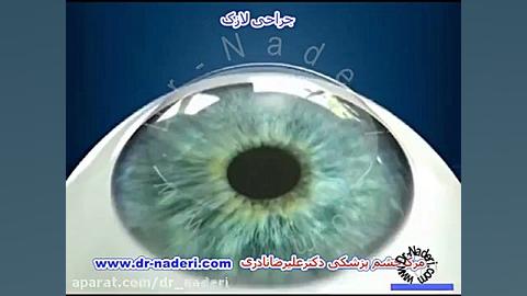 نحوه انجام عمل جراحی لازک مرکز چشم پزشکی دکتر علیرضا نادری www.dr-naderi.com