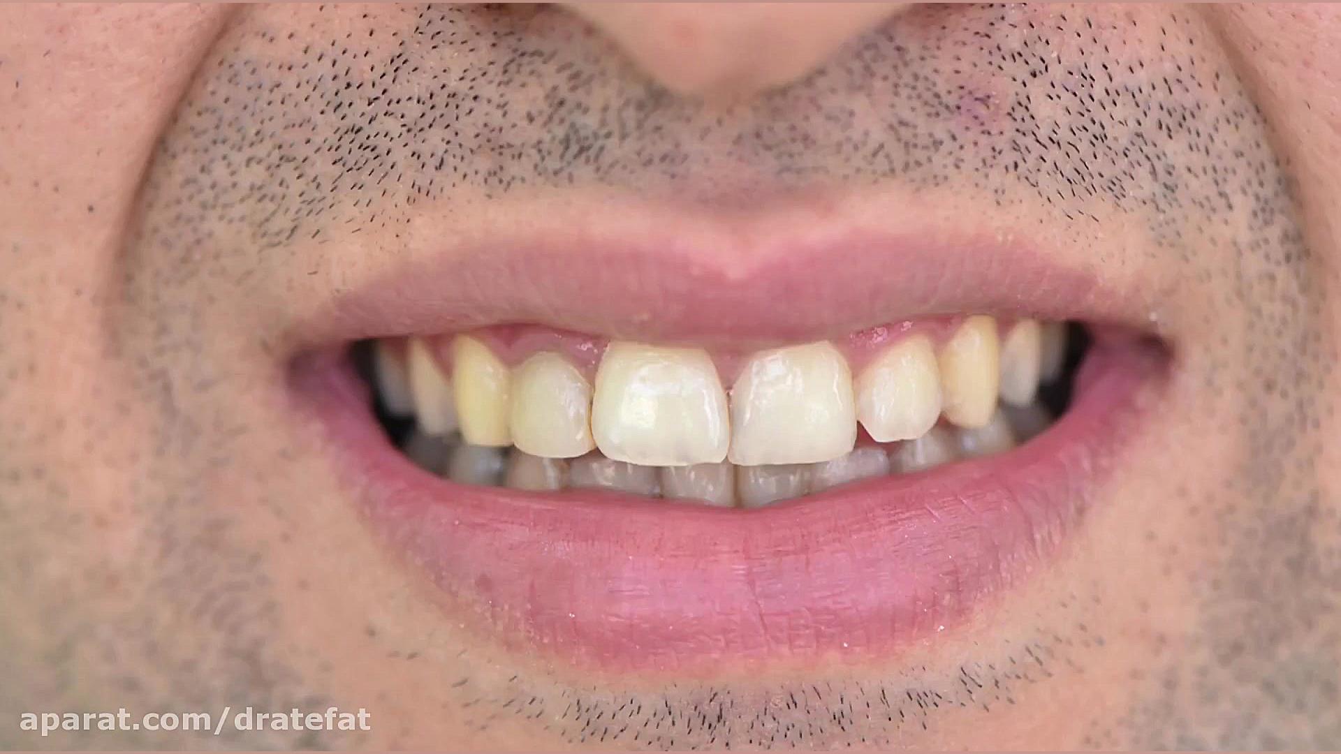 ونیر کامپوزیت دندان های دوفک ،اصفهان-دکتر محمد عاطفت متخصص دندانپزشکی زیبایی دکتر محمد عاطفت متخصص ترمیمی و زیبایی اصفهان