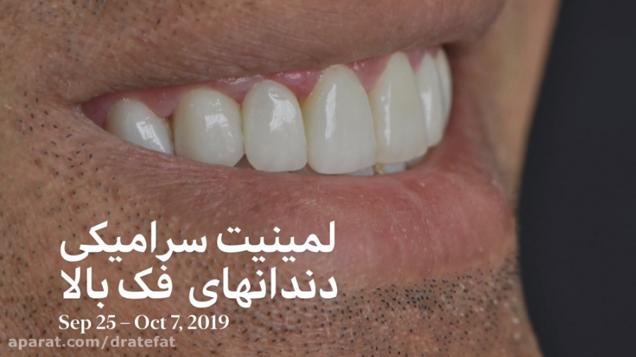 لمینیت سرامیکی دندان های فک بالا ،دکتر عاطفت متخصص ترمیمی اصفهان بیماری نوری آسیب ارثی