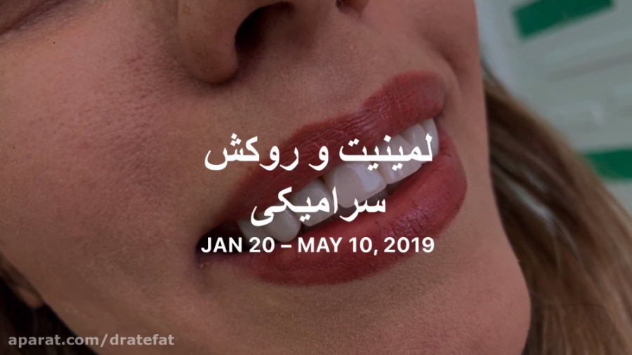 لمینیت و روکش سرامیکی اصفهان دکتر محمد عاطفت متخصص ترمیمی زیبایی دکتر محمد عاطفت متخصص ترمیمی و زیبایی اصفهان