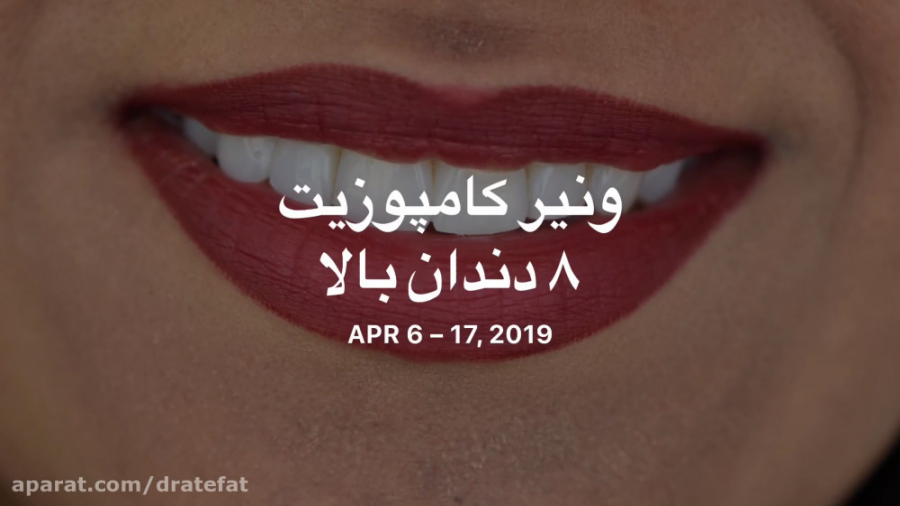 ونیر کامپوزیت 8 دندان بالا اصفهان دکتر محمد عاطفت متخصص ترمیمی زیبایی دکتر محمد عاطفت متخصص ترمیمی و زیبایی اصفهان