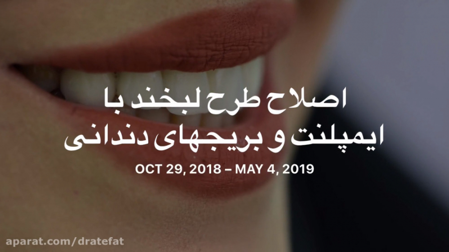 ایمپلنت و بریج های دندانی در اصفهان توسط دکتر محمد عاطفت متخصص زیبایی دکتر محمد عاطفت متخصص ترمیمی و زیبایی اصفهان