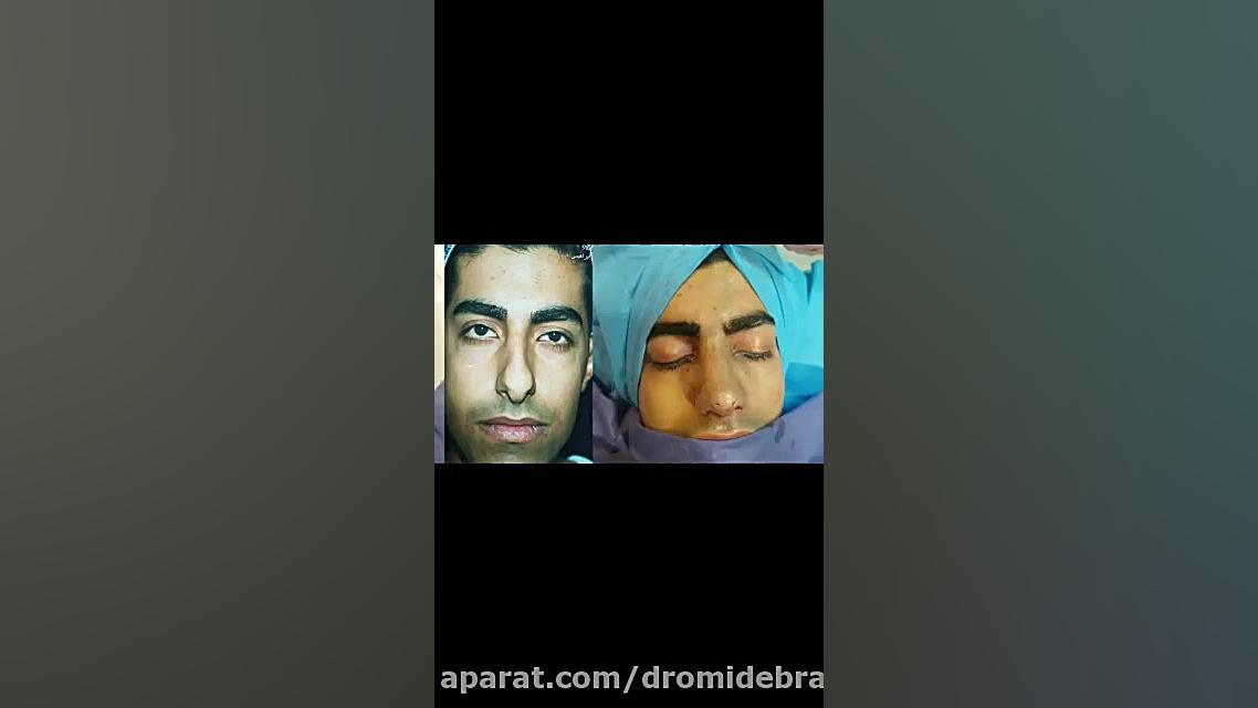 جراحی انحراف و افتادگی نوک بینی توسط دکتر امید ابراهیمی بهترین جراح بینی تهران دکتر امید ابراهیمی