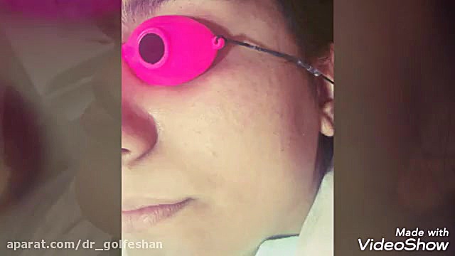 درمان لک صورت با لیزر لیفت صورت