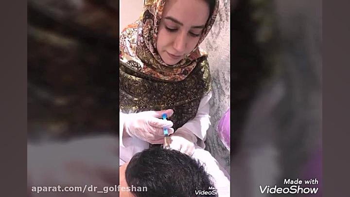 درمان ریزش مو با مزوتراپی دکتر عاطفه گلفشان، متخصص پوست مو و لیزر درمانی