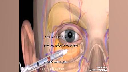 درمان چروکهای دور چشم و تیرگی آن با مزو دکتر عاطفه گلفشان، متخصص پوست مو و لیزر درمانی