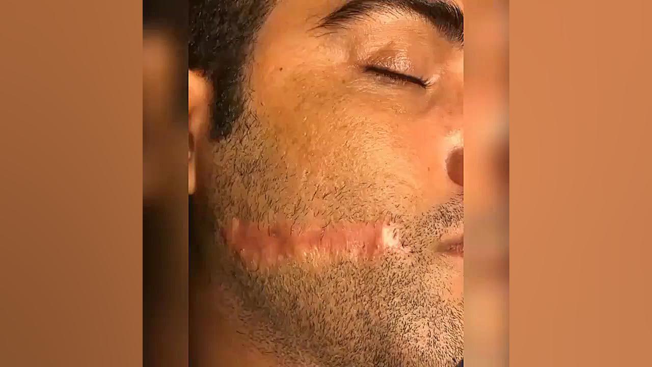 کاشت ریش 22807060 سیستم نانواینژکتور