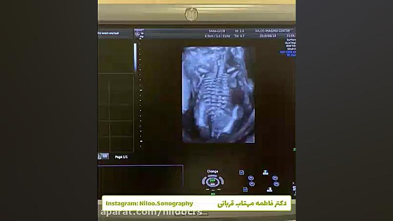 ستون فقرات جنین - سونوگرافی سونوگرافی نیلو دکتر فاطمه مهتاب قربانی